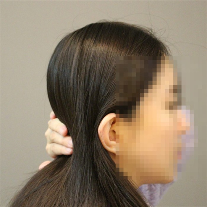 韓國雕刻整形外科后腦勺 填充整形，頭型大變無死角！—韓國雕刻整形外科整形案例