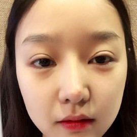 韩国VG整形外科各类眼型的眼部修复手术日记