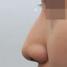 韩国JF皮肤科隆鼻前后对比图！—韩国JF皮肤科