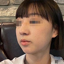 韩国优雅人整形外科做鹰钩鼻手术对比展示！—韩国优雅人整形外科