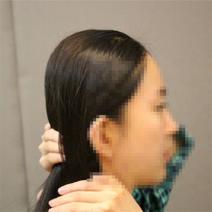 韓國雕刻整形外科后腦勺 填充整形，頭型大變無死角！—韓國雕刻整形外科整形案例