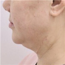 韓國儷伴整形外科臉部吸脂+提拉三個月對比圖！—韓國儷伴整形外科整形案例