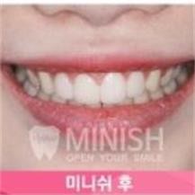 韩国今日安minish牙科—牙齿矫正案例对比