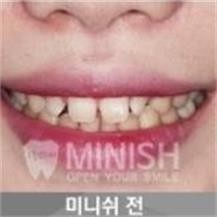 韩国今日安minish牙科—牙齿矫正案例对比