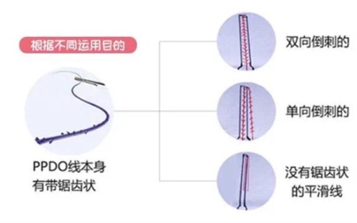 脸垮了怎么办？姚兆林3D立体提升术让我重获小V脸！—江苏宿迁奕美美容医院整形日记