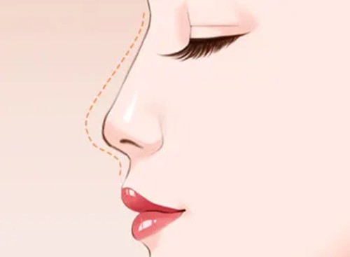 塌鼻女孩逆袭侧颜杀？上饶佑美鼻综合真实蜕变记！_韩国整形真实日记日记