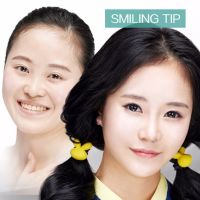 矫正笑的时候鼻尖往下垂的鼻肌SMILING TIP-SMILING TIP-韩国佰诺佰琪(原：巴诺巴奇)整形外科