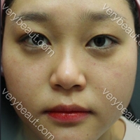 脸上的小色素和肉肉脸！最大的烦恼！溶脂针+激光—韩国童颜中心医院