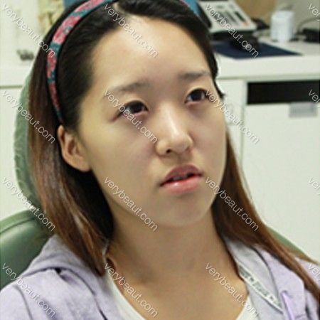 她的小眼变成让人羡慕的大眼—韩国灰姑娘整形医院整形日记