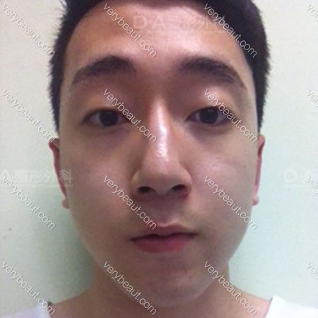 [男士整形]-Lee-Young-Wook—韩国DA整形医院整形日记