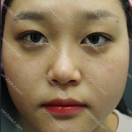 脸上的小色素和肉肉脸！最大的烦恼！溶脂+激光—韩国童颜中心医院整形日记