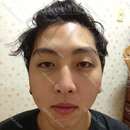男士整形-Kim-Woo-Yong—韩国DA整形医院整形案例