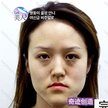 成为历代最强美女的方美晶—韩国菲斯莱茵整形外科整形案例