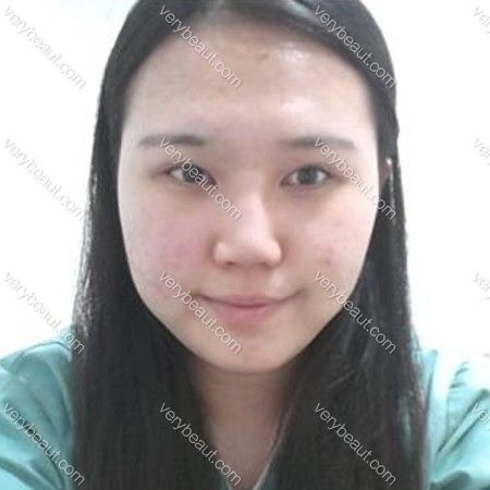 宣智的面部轮廓+眼睛+鼻子+额头整形后记—韩国佰诺佰琪(原：巴诺巴奇)整形外科整形案例