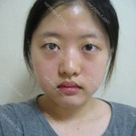 爱琳的眼睛+鼻部+额头整形后记—韩国佰诺佰琪(原：巴诺巴奇)整形外科整形日记
