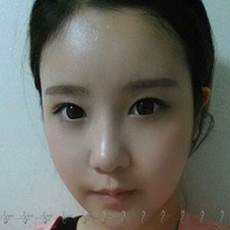 论娃娃脸是如何炼成的-真人秀模特后记—韩国A特整形医院整形日记