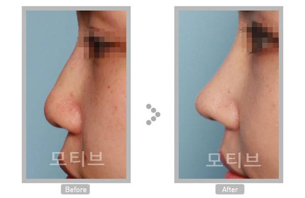韩国MOTIVE整形外科医院 美感的眼睛修复手术和鼻子修复手术2