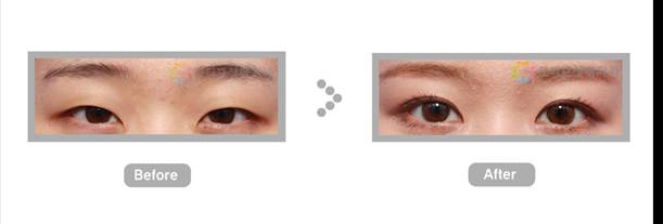 韩国MOTIVE整形外科医院 美感的眼睛修复手术和鼻子修复手术4