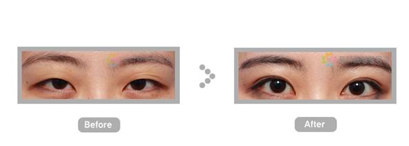 韩国MOTIVE整形外科医院 美感的眼睛修复手术和鼻子修复手术3