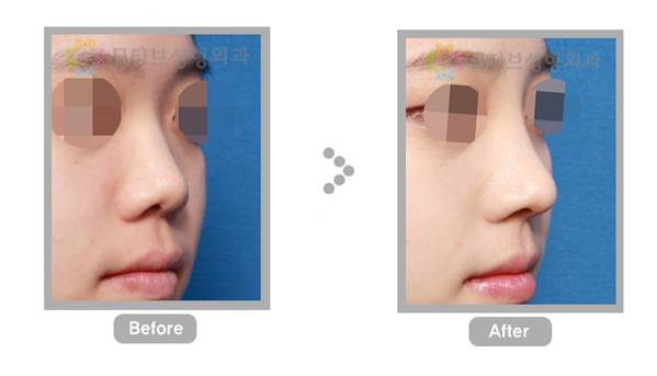 韩国MOTIVE整形外科医院 美感的眼睛修复手术和鼻子修复手术1