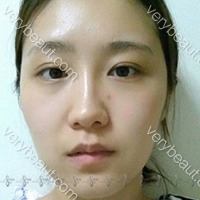 论娃娃脸是如何炼成的-真人秀模特后记—韩国A特整形医院