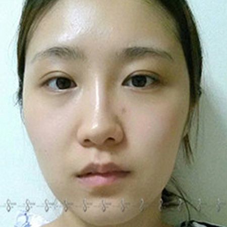 论娃娃脸是如何炼成的-真人秀模特后记—韩国A特整形医院整形日记