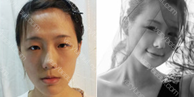 韩国原辰整形外科医院 拯救了我的”大长脸+地包天”