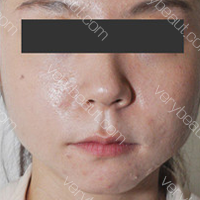 V-line轮廓针无需手术，打造精致小脸—韩国丽妍K整形医院