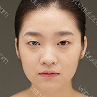 单眼皮+下颌角+塌鼻子 整套手术下来大换脸—韩国爱我整形外科