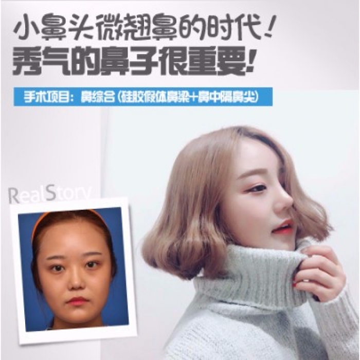 韩国丽延长整形外科--鼻综合手术  小鼻头微翘鼻时代来临