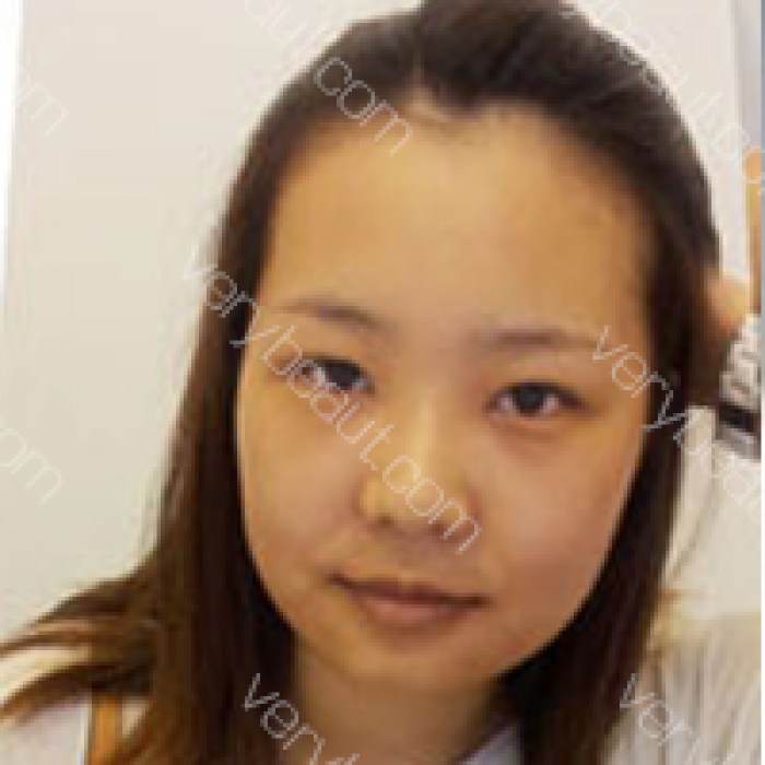 双眼皮修复+颧骨+下颌角+毛发移植,效果惊呆了!!!—韩国欧佩拉整形外科整形日记