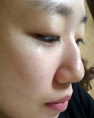 双眼皮+驼峰鼻矫正 术后效果看CooKi整形医院真实日记_韩国CooKi整形外科医院