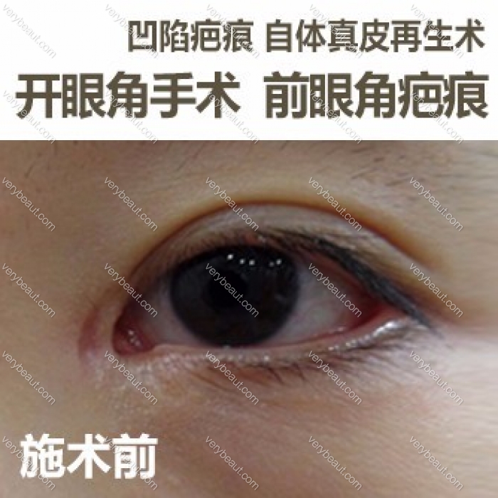 自体真皮再生术——开眼角疤痕的克星_韩国陈整形外科医院