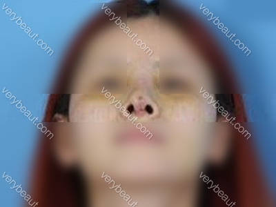 硅胶假体隆鼻感染