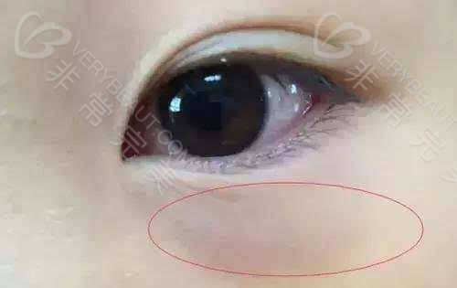 血管型黑眼圈