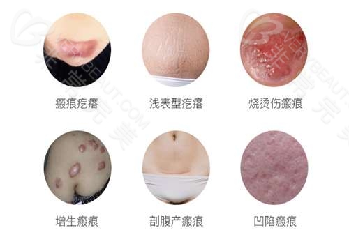 上海清沁医疗疤痕类型