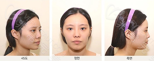 韩国TS整形外科医院面部轮廓整形术前照片