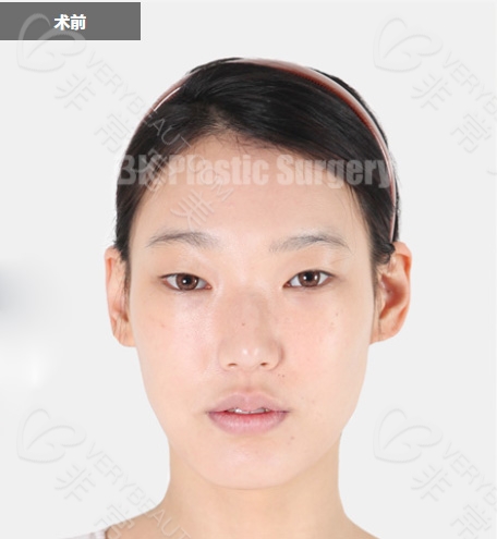 韩国BK整形美容医院双眼皮整形术前