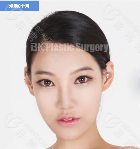 韩国BK整形美容医院双眼皮整形术后