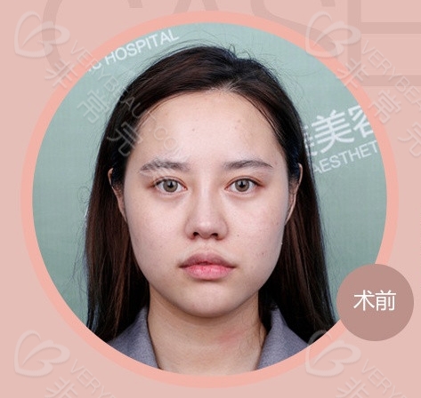 南京华美医疗美容医院鼻部综合整形手术前照片
