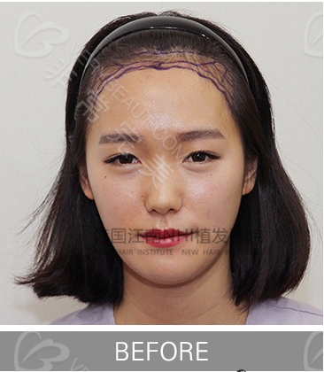 韩国NHI植发医院发际线矫正手术前