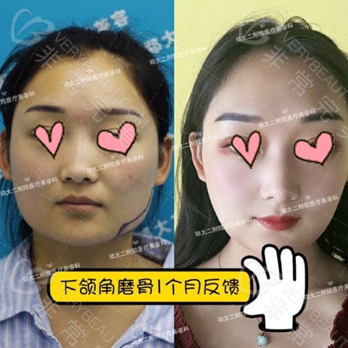 河南郑州大学第二附属医院李钢磨骨手术对比照片