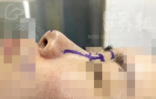 南京鼻祖医院鼻综合整形手术前照片