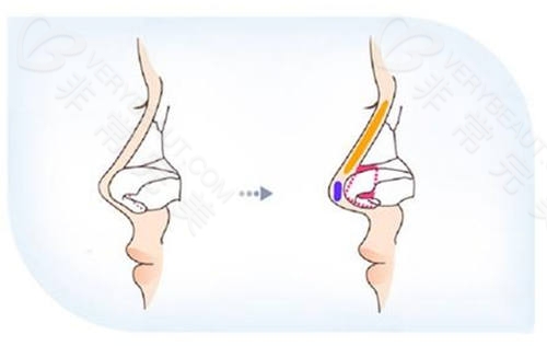 自体软骨加假体的隆鼻方式
