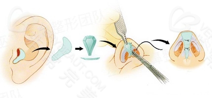耳软骨隆鼻手术流程