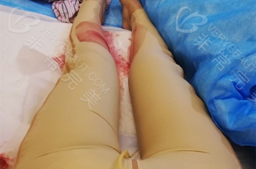 大腿吸脂术后异常肿胀期