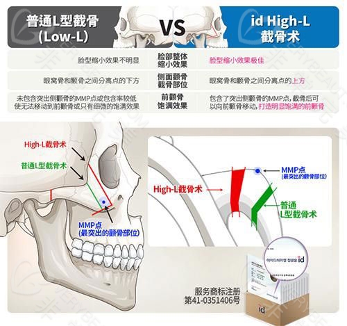 L型颧骨缩小和I颧骨缩小手术的区别