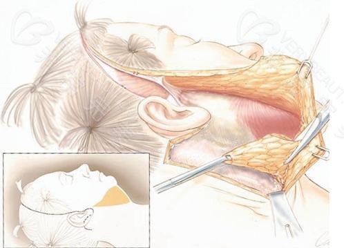 拉皮手术皮肤组织和筋膜分离图
