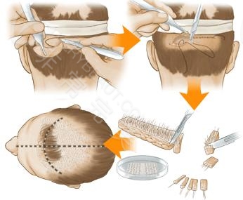 植发之后还会再脱发吗?一分钟带你了解毛发移植原理和过程!