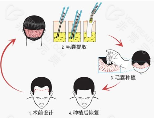 植发的过程示意图